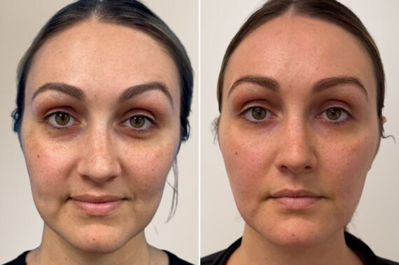 Facial Balance Before and After Photos in Philadelphia, PA, Patient 19471