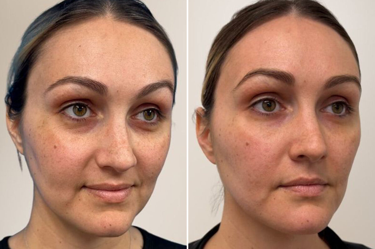 Facial Balance Before and After Photos in Philadelphia, PA, Patient 19471