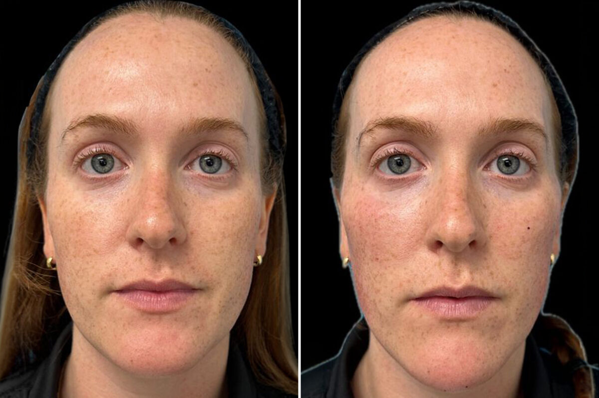 Facial Balance Before and After Photos in Philadelphia, PA, Patient 19478