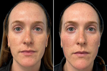Facial Balance Before and After Photos in Philadelphia, PA, Patient 19478
