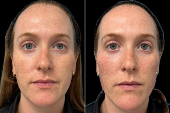 Facial Balance Before and After Photos in Philadelphia, PA, Patient 19478