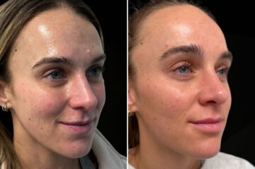 Facial Balance Before and After Photos in Philadelphia, PA, Patient 19482