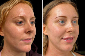 Facial Balance Before and After Photos in Philadelphia, PA, Patient 19486