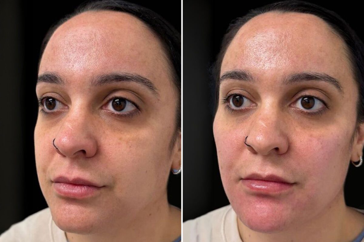 Facial Balance Before and After Photos in Philadelphia, PA, Patient 19490