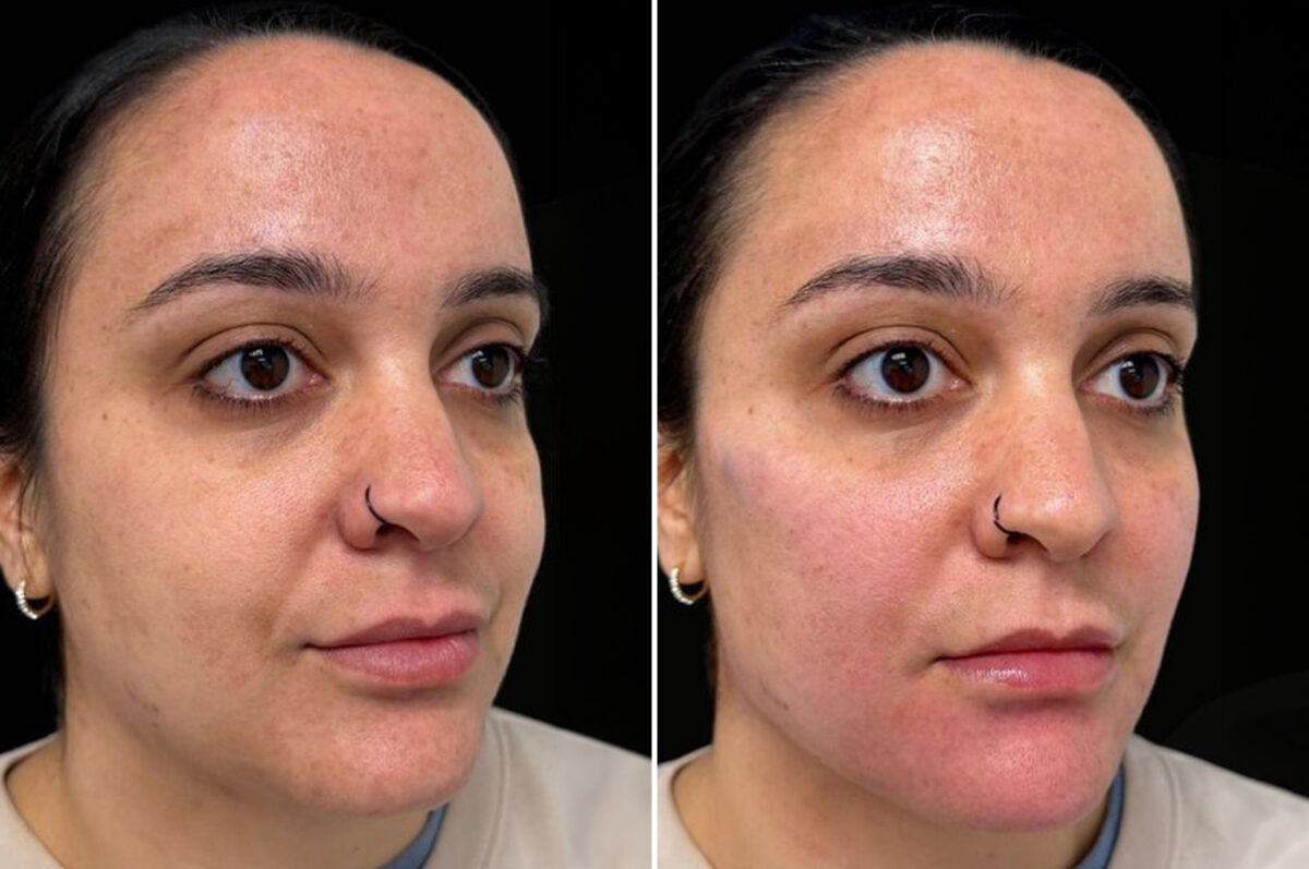 Facial Balance Before and After Photos in Philadelphia, PA, Patient 19490