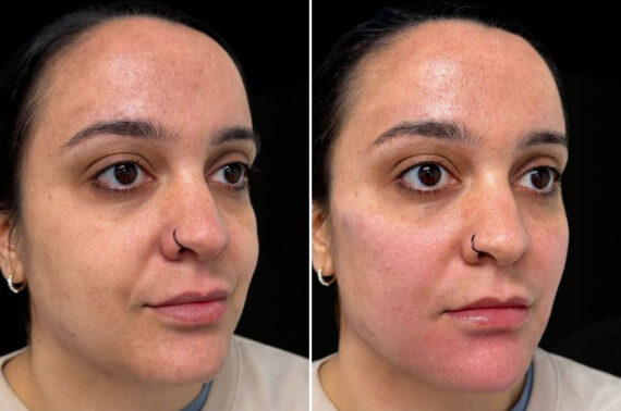 Facial Balance Before and After Photos in Philadelphia, PA, Patient 19490