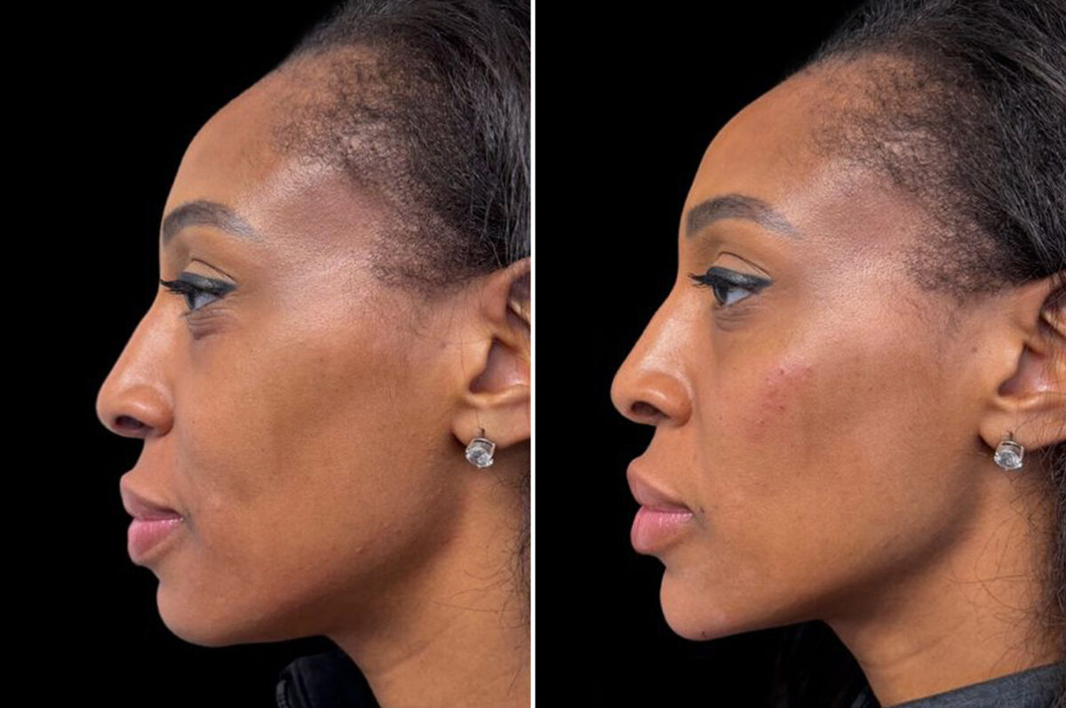 Injectable Fillers Before and After Photos in Philadelphia, PA, Patient 19497