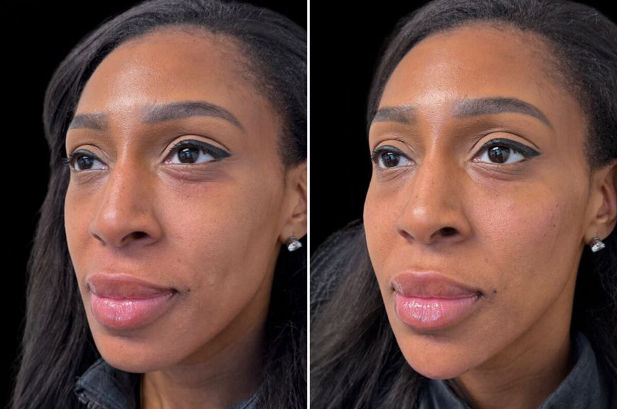 Injectable Fillers Before and After Photos in Philadelphia, PA, Patient 19497