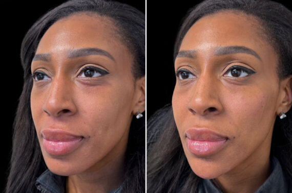 Injectable Fillers Before and After Photos in Philadelphia, PA, Patient 19497