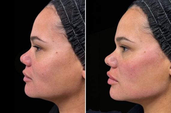 Injectable Fillers Before and After Photos in Philadelphia, PA, Patient 19504