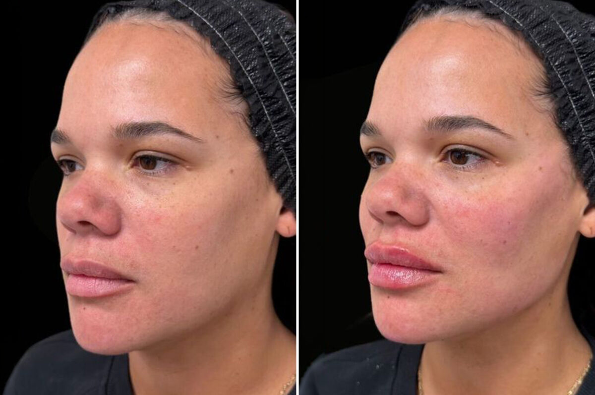 Injectable Fillers Before and After Photos in Philadelphia, PA, Patient 19504