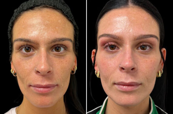 Botox Before and After Photos in Philadelphia, PA, Patient 19511