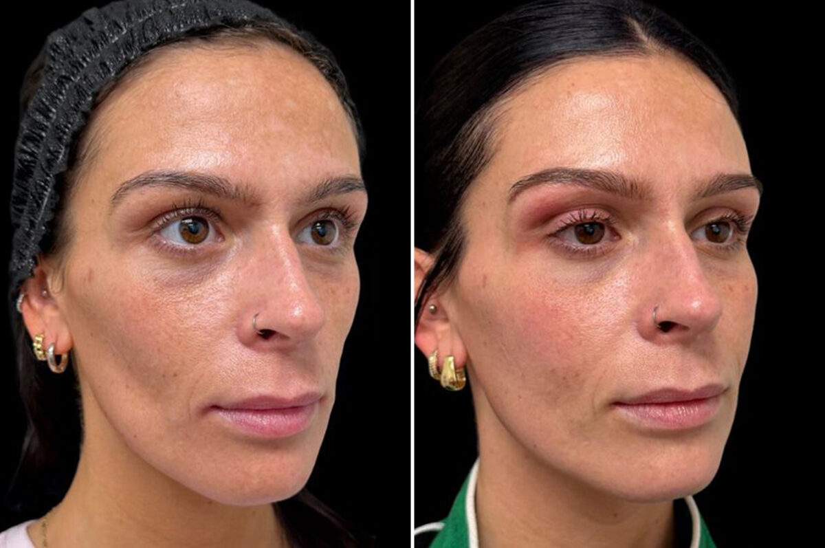 Botox Before and After Photos in Philadelphia, PA, Patient 19511