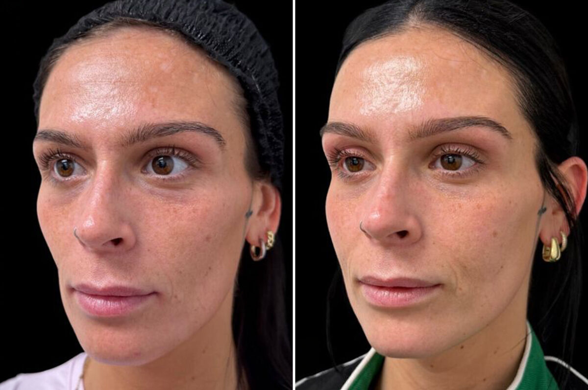 Botox Before and After Photos in Philadelphia, PA, Patient 19511