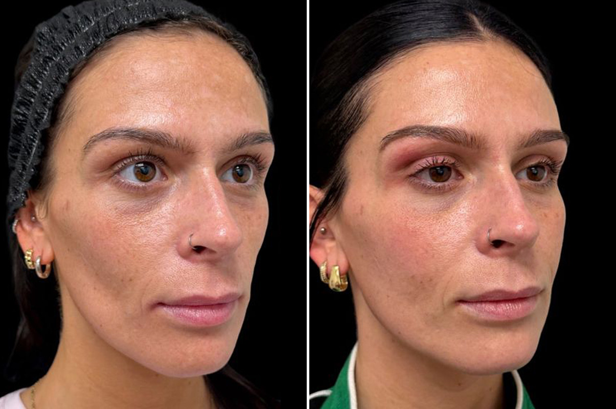 patient-19511-botox-before-after
