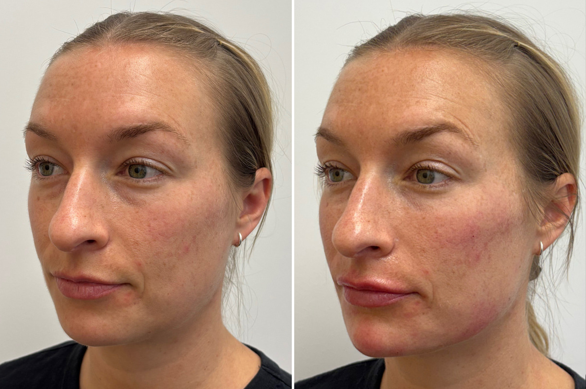 patient-19725-facial-balance-before-after