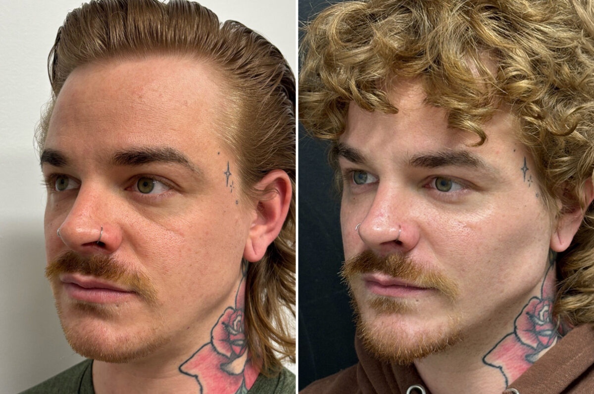 Facial Balance Before and After Photos in Philadelphia, PA, Patient 19729