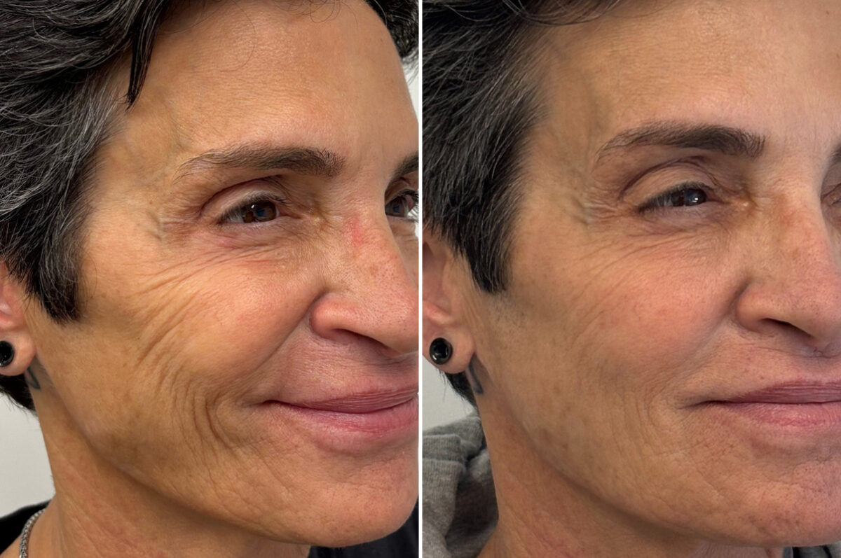 Injectable Fillers Before and After Photos in Philadelphia, PA, Patient 19733