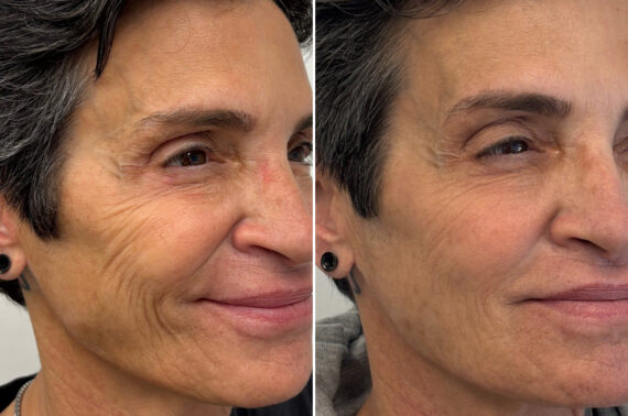 Injectable Fillers Before and After Photos in Philadelphia, PA, Patient 19733