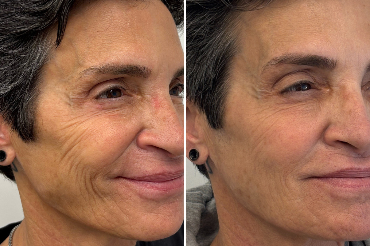 patient-19733-injectable-fillers-before-after