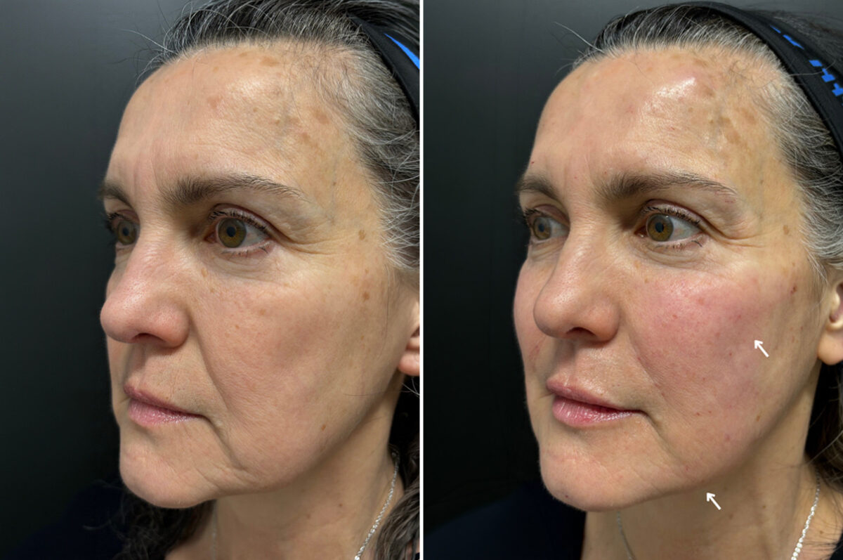 Injectable Fillers Before and After Photos in Philadelphia, PA, Patient 19737