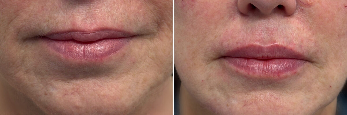 Injectable Fillers Before and After Photos in Philadelphia, PA, Patient 19743