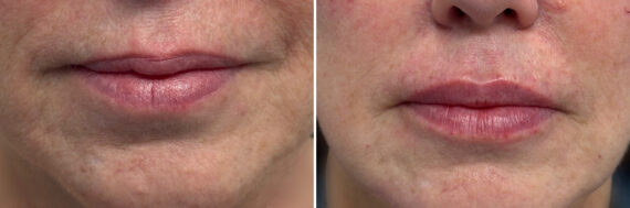 Injectable Fillers Before and After Photos in Philadelphia, PA, Patient 19743