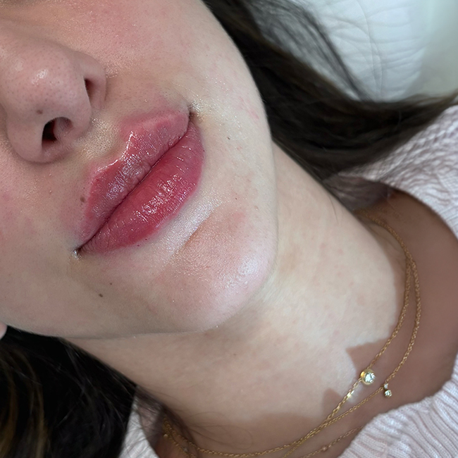 lip-filler-before-after-new