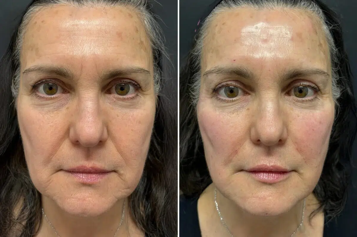 Injectable Fillers Before and After Photos in Philadelphia, PA, Patient 19737