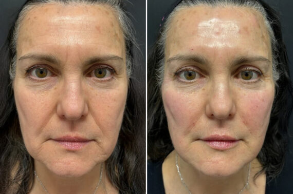 Injectable Fillers Before and After Photos in Philadelphia, PA, Patient 19737