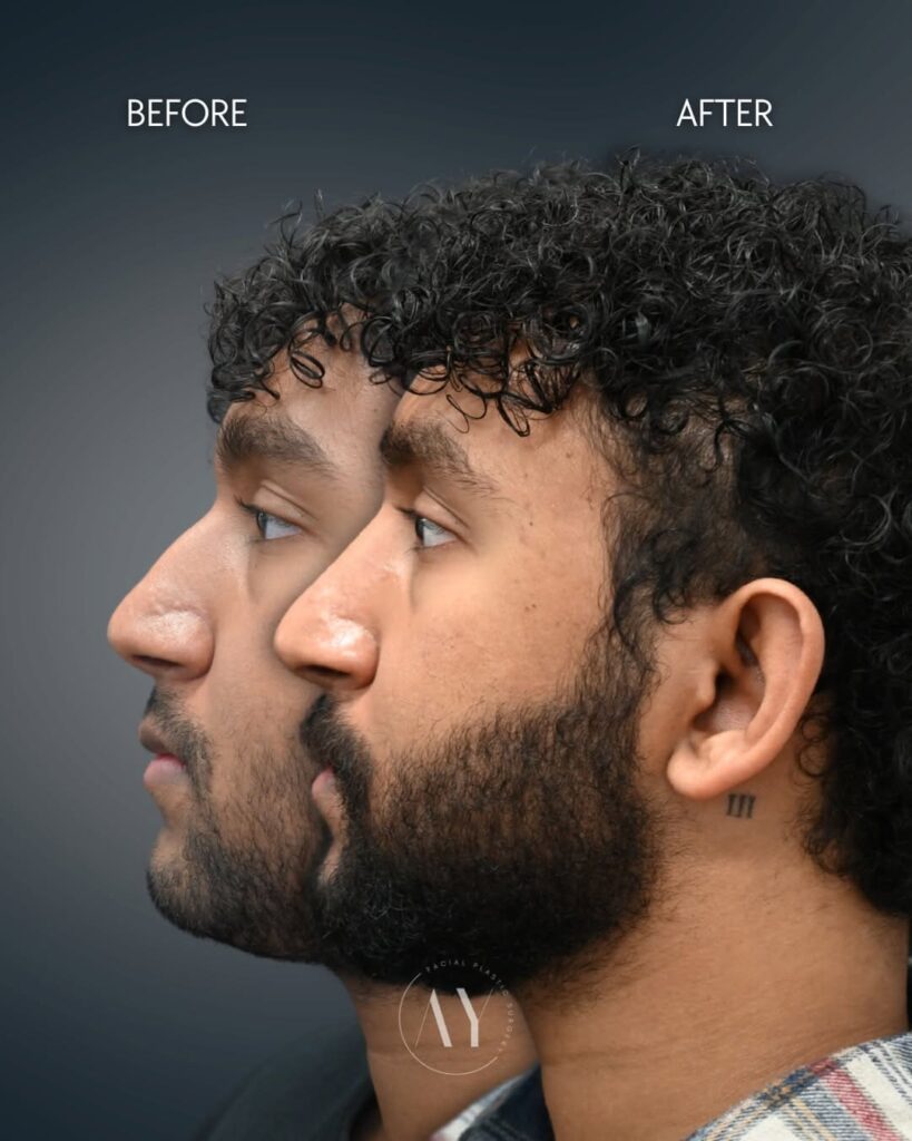 Before-and-after rhinoplasty results showing improved nasal contour and facial balance over long-term healing progression.