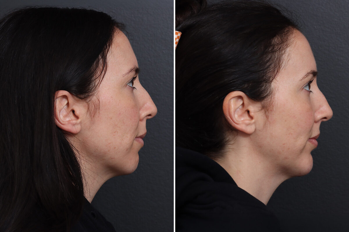 Chin Implants Before and After Photos in Princeton, NJ, Patient 21106