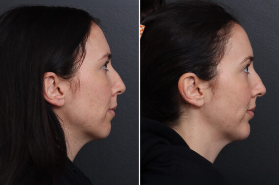 Chin Implants Before and After Photos in Princeton, NJ, Patient 21106