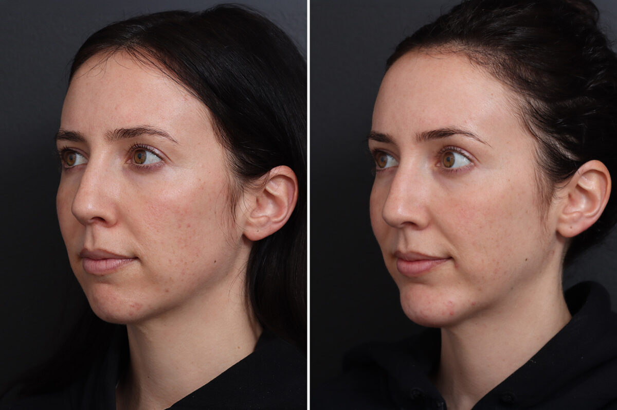 Chin Implants Before and After Photos in Princeton, NJ, Patient 21106