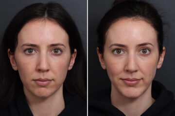 Chin Implants Before and After Photos in Princeton, NJ, Patient 21106