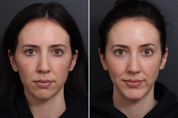 Chin Implants Before and After Photos in Princeton, NJ, Patient 21106
