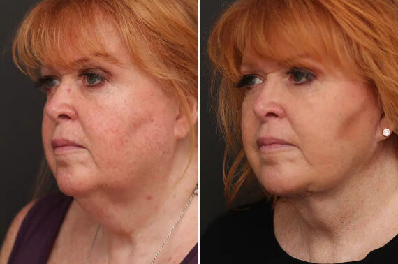 Facelift Before and After Photos in Princeton, NJ, Patient 21116