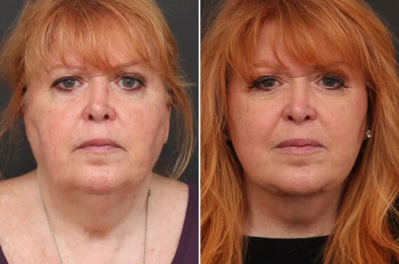 Facelift Before and After Photos in Princeton, NJ, Patient 21116