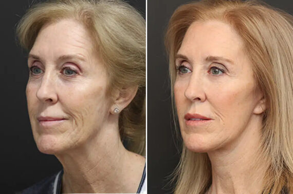 Facelift Before and After Photos in Princeton, NJ, Patient 21182