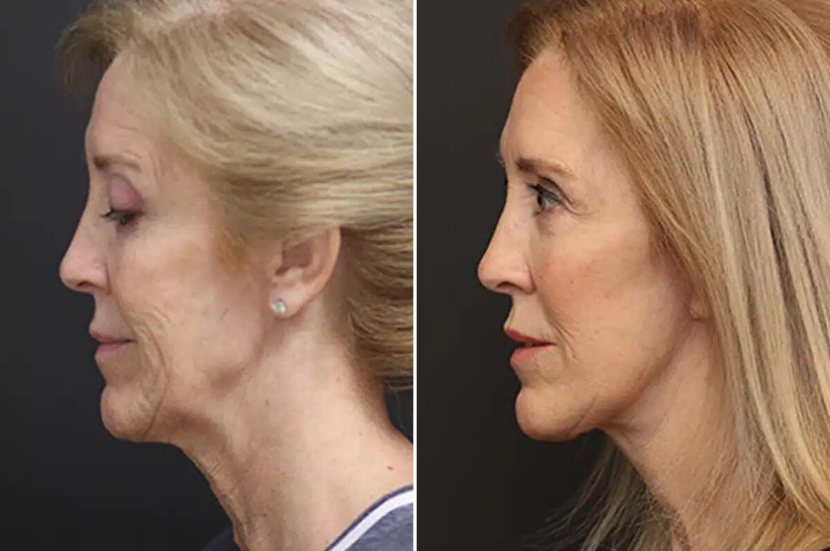 Facelift Before and After Photos in Princeton, NJ, Patient 21182