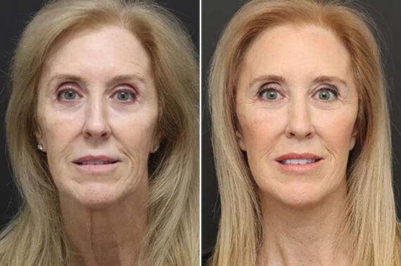 Facelift Before and After Photos in Princeton, NJ, Patient 21182