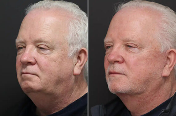 Facelift Before and After Photos in Princeton, NJ, Patient 21186