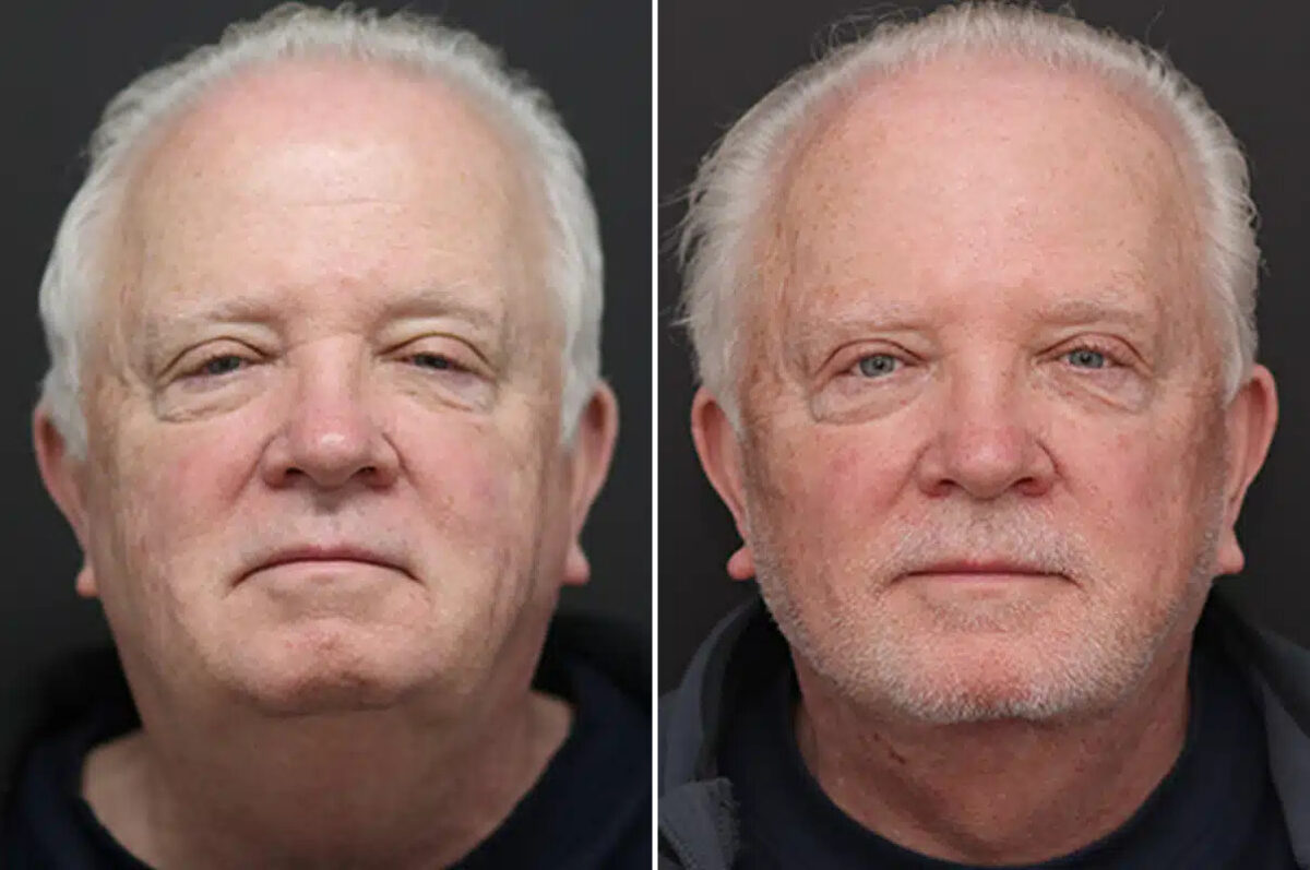 Facelift Before and After Photos in Princeton, NJ, Patient 21186