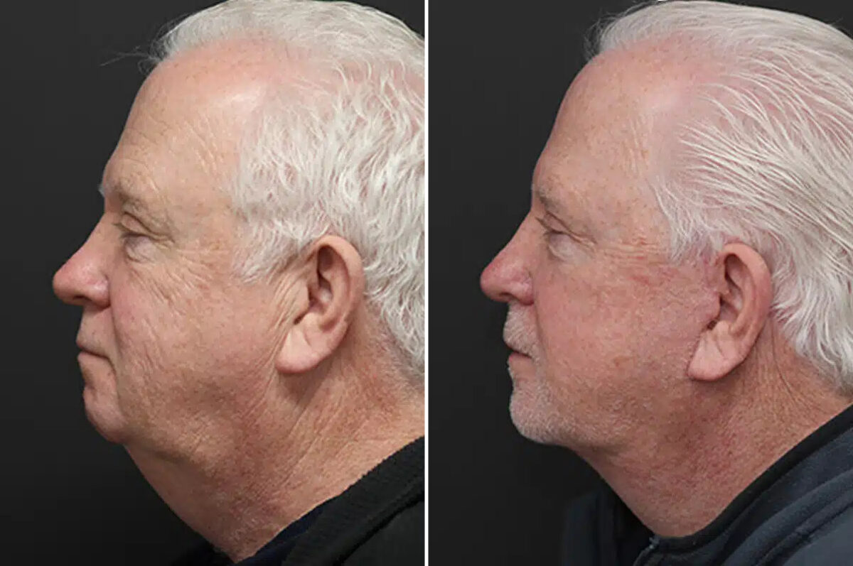 Facelift Before and After Photos in Princeton, NJ, Patient 21186