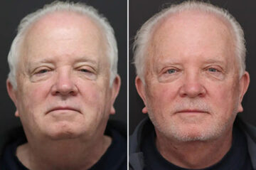 Facelift Before and After Photos in Princeton, NJ, Patient 21186
