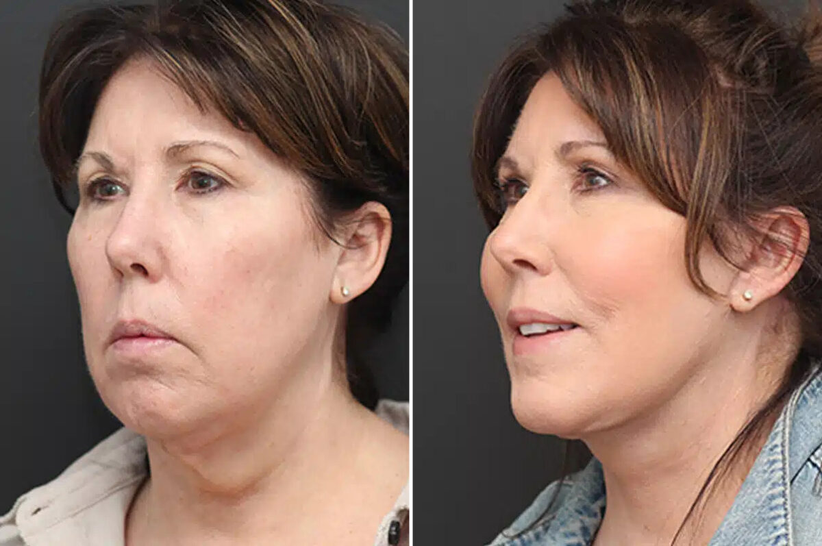 Facelift Before and After Photos in Princeton, NJ, Patient 21190