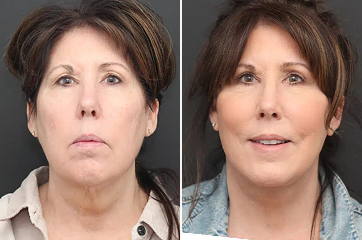Facelift Before and After Photos in Princeton, NJ, Patient 21190