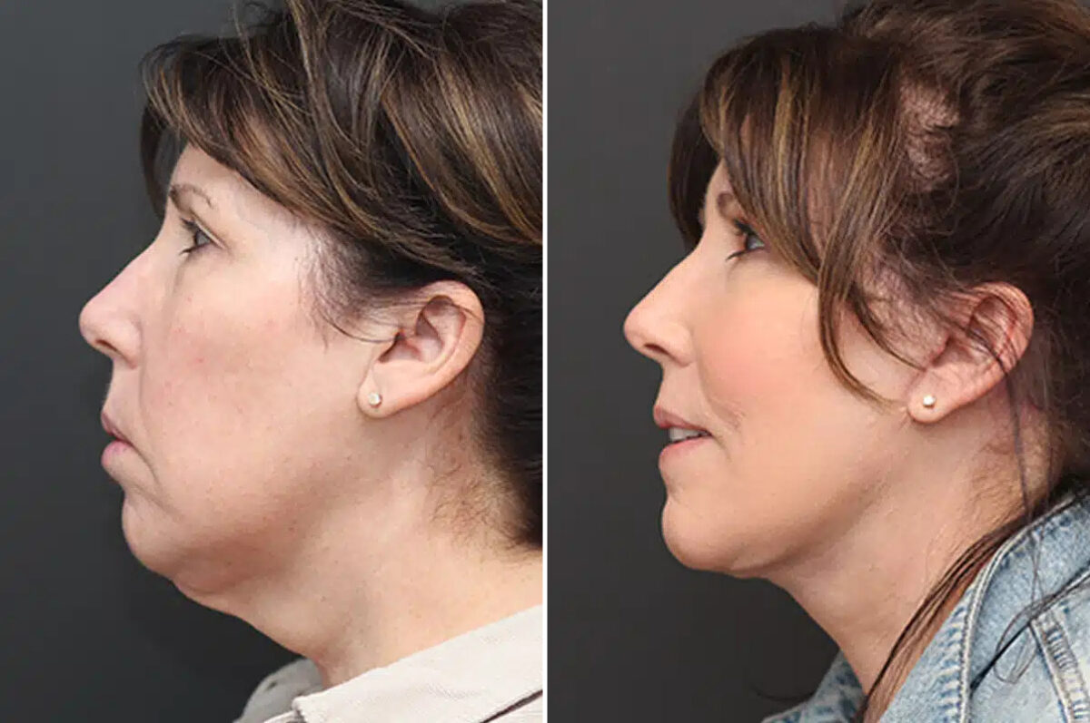 Facelift Before and After Photos in Princeton, NJ, Patient 21190