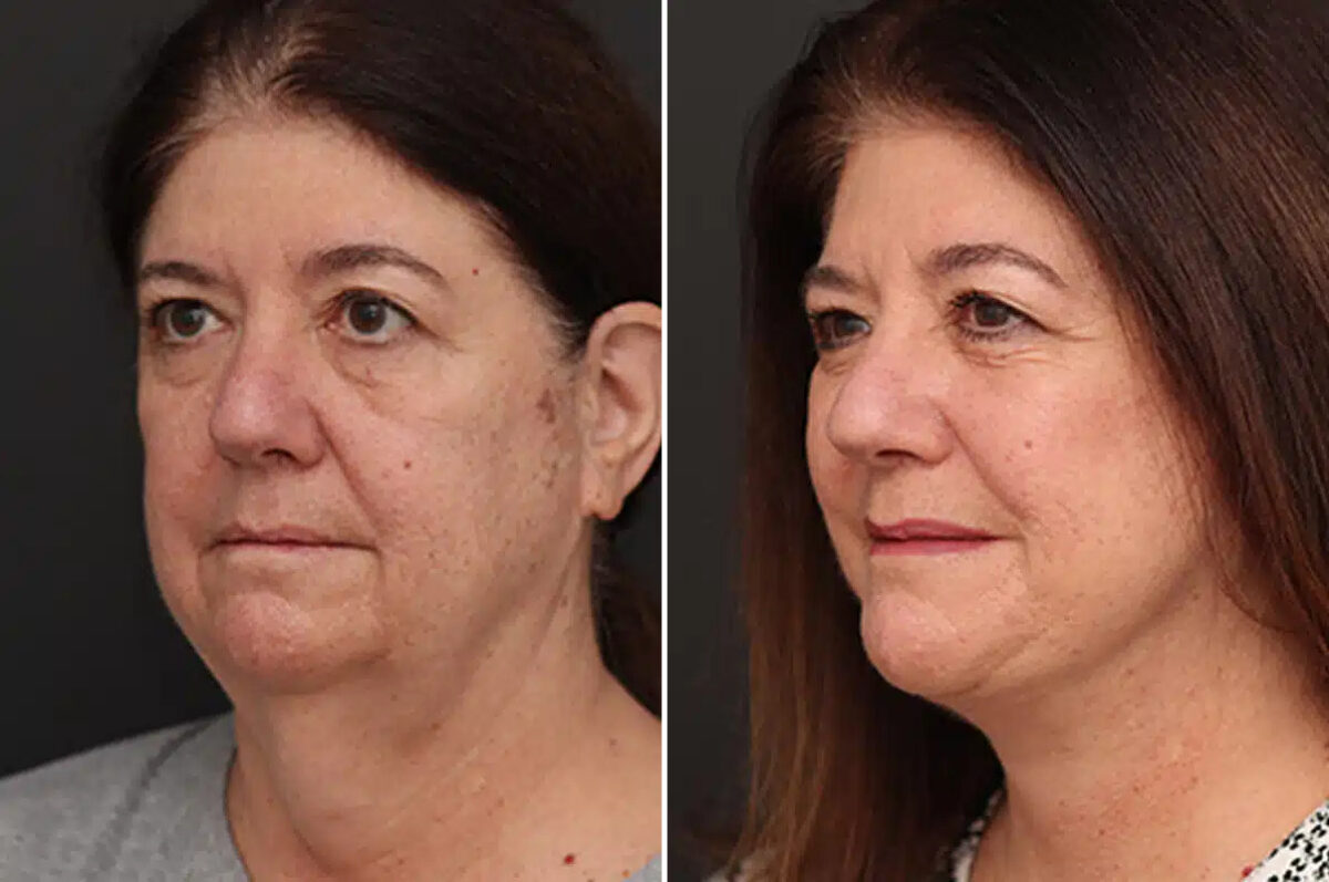 Facelift Before and After Photos in Princeton, NJ, Patient 21194