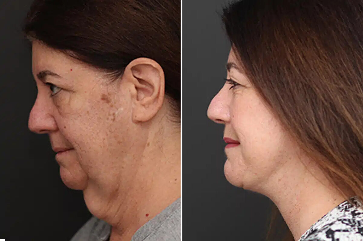Facelift Before and After Photos in Princeton, NJ, Patient 21194